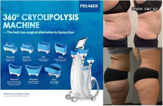 Cryolipolisis-thumb-2