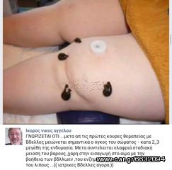 Ιατρικές Βδέλλες-thumb-9